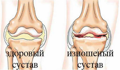 Артроз коленного сустава лечение пермь